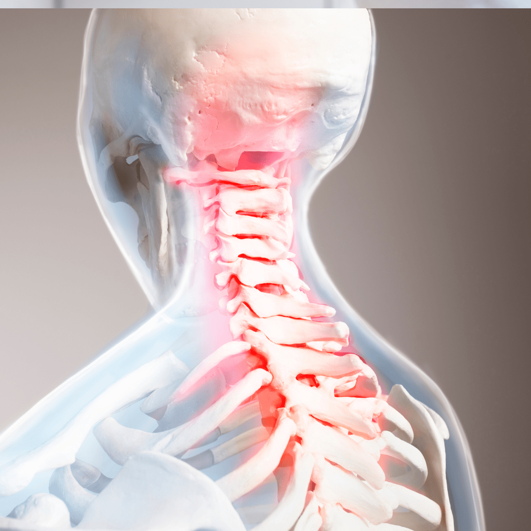Hernias cervicales: síntomas, diagnóstico y tratamientos
