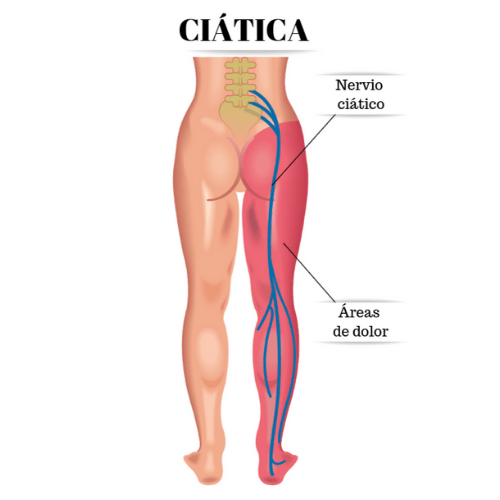 Ciática | Causas y remedios para aliviar el dolor