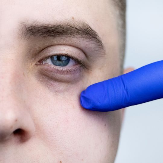 5 remedios naturales para eliminar las ojeras