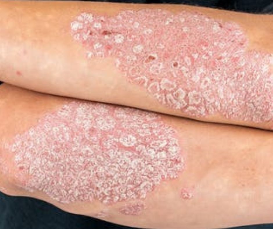 Remedio para la Psoriasis